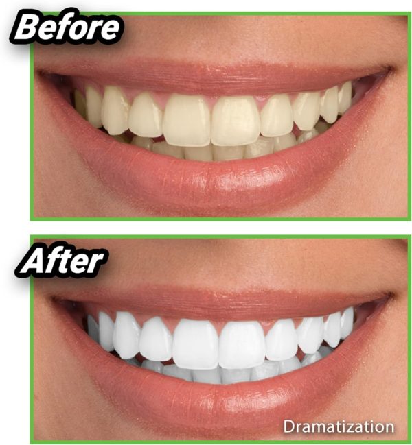 Miracle Teeth Whitener 3